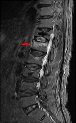 Case report: Inspiration from a rare fatal heart perforation after percutaneous vertebroplasty